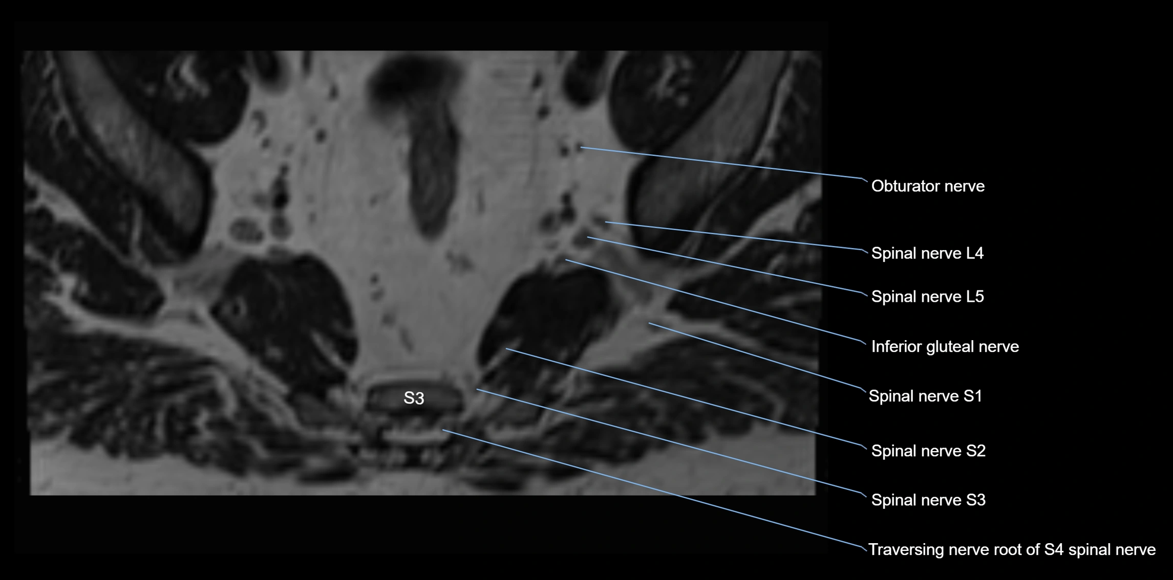 MR lumbosacral plexus axial cross sectional anatomy 3T  radiology  image-img-1008001-00095.webp